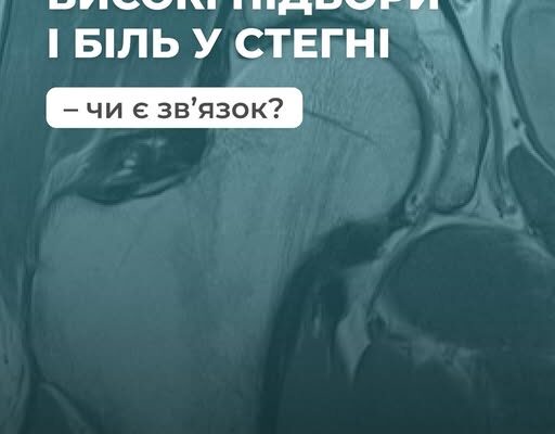 Високі підбори й біль у стегні — чи є зв’язок?