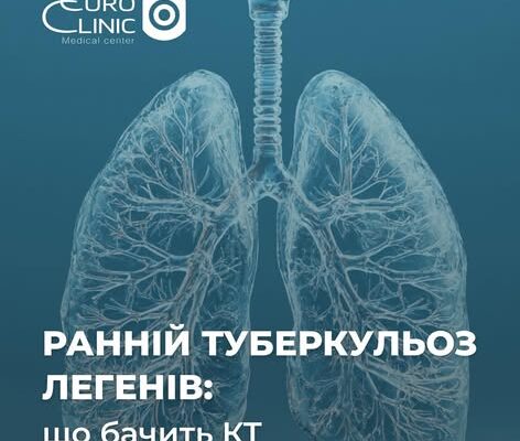 Ранній туберкульоз легенів — що покаже КТ?