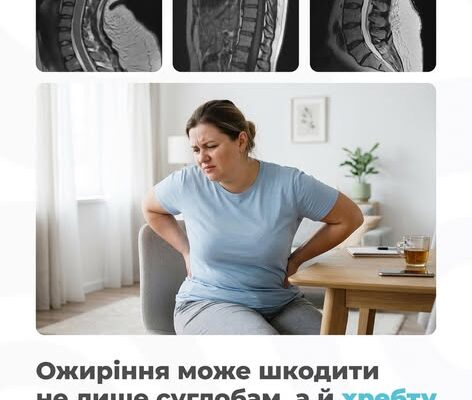 Ожиріння може шкодити не лише суглобам, а й хребту