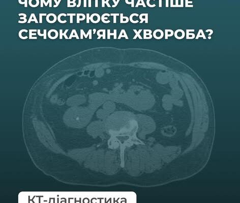 Чому влітку частіше загострюється сечокам’яна хвороба? ☀️